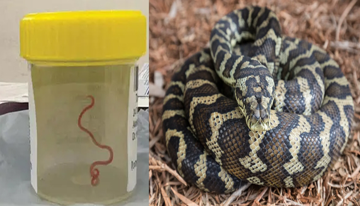 दुनिया का पहला मामला, महिला के दिमाग में मिला जिंदा कीड़ा!