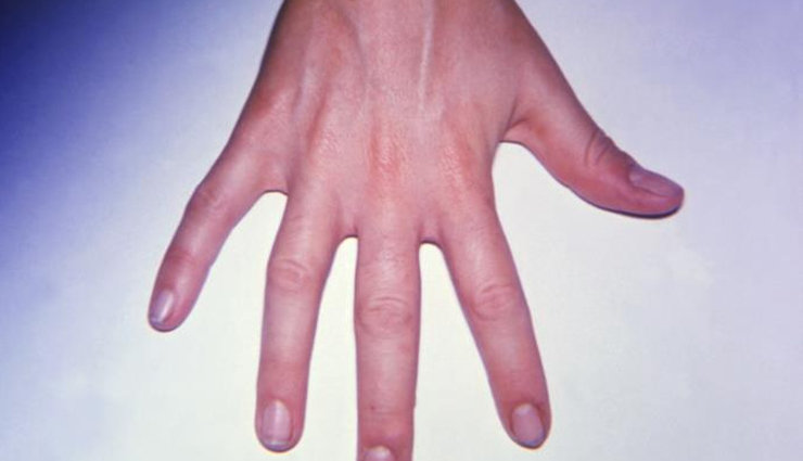 soursop,health benefits of soursop,Health tips,fitness tips