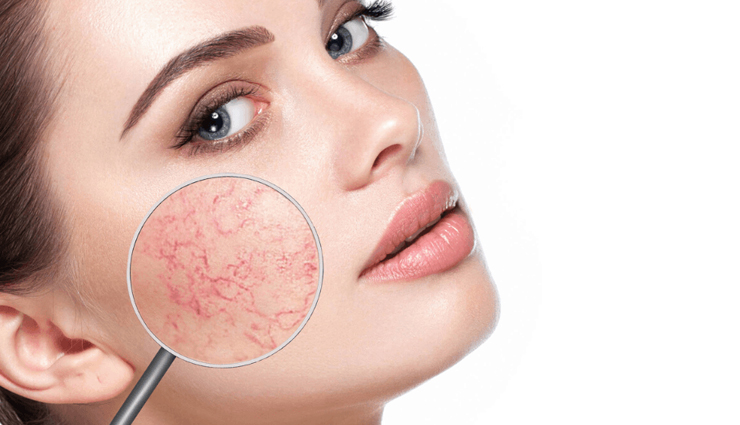 8 Steps To Hide Your Spider Veins Using Makeup