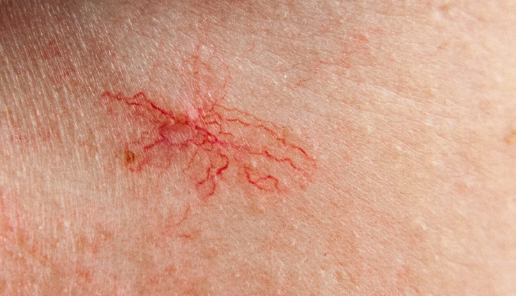 liver damage signs,skin abnormalities liver damage,blue rashes liver disease,skin itching liver damage,spider angioma liver dysfunction,halitosis liver impairment,palmar erythema liver damage,facial hyperpigmentation liver dysfunction,liver health warning signs,symptoms of liver damage