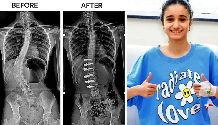 डॉक्टर्स ने लड़की की स्पाइन को रस्सी से बनाया, सर्जरी के अगले ही दिन लगी चलने