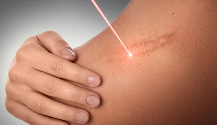 spotless skin,natural ways to get spotless skin,glycerin beauty benefits,lemon juice beauty benefits,beauty tips,skin care tips