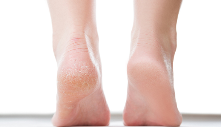 spotless skin,natural ways to get spotless skin,glycerin beauty benefits,lemon juice beauty benefits,beauty tips,skin care tips