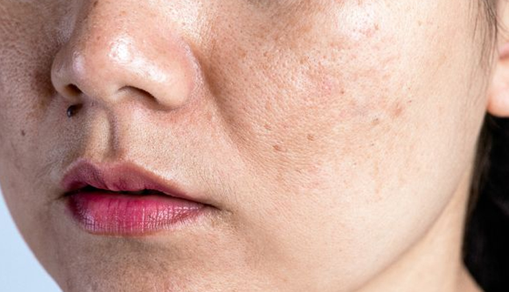 spotless skin,natural ways to get spotless skin,glycerin beauty benefits,lemon juice beauty benefits,beauty tips,skin care tips