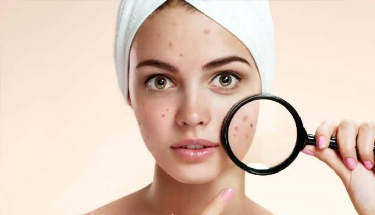 hydrogen peroxide acne treatment,benefits of hydrogen peroxide for acne,hydrogen peroxide as a spot treatment,diluted hydrogen peroxide solution for acne,hydrogen peroxide face wash for acne,hydrogen peroxide mask for acne,steam treatment with hydrogen peroxide for acne,caution when using hydrogen peroxide for acne,dermatologist recommendations for acne treatment,hydrogen peroxide and acne-prone skin,hydrogen peroxide for acne scars,hydrogen peroxide skincare routine for acne,acne prevention with hydrogen peroxide,hydrogen peroxide side effects on skin,hydrogen peroxide effectiveness on acne bacteria,diy acne treatment with hydrogen peroxide,hydrogen peroxide for clearing pores,using hydrogen peroxide safely for acne,hydrogen peroxide for acne breakout prevention,hydrogen peroxide vs. other acne treatments