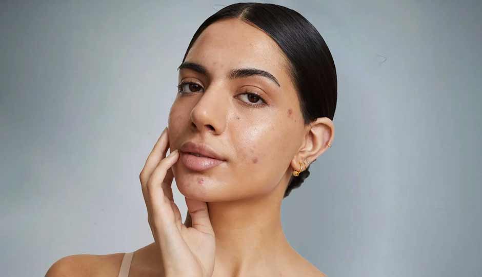 15 Home Remedies to Treat Spots on Face Naturally