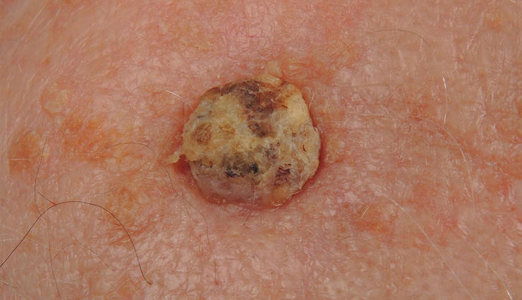 skin cancer symptoms,skin cancer types,skin cancer on face,skin cancer treatment,skin cancer on nose,skin cancer black skin,skin cancer by race,vitamin b skin cancer benefits,skin cancer color,skin cancer center,skin cancer cream,skin cancer color ribbon,vitamin c skin cancer treatment,vitamin c skin cancer prevention,skin cancer diagnosis,skin cancer detection,vitamin d skin cancer,vitamin d skin cancer treatment