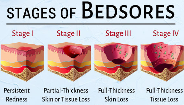 bedsores,different stages of bedsores,types of bedsores,bedsore problem,Health,Health tips,healthy living