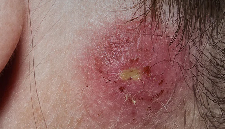 7 Natural Remedies To Treat Staph Infection