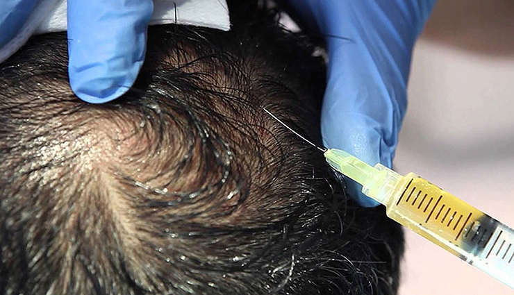 cell therapy for hair baldness,stem cell therapy for hair baldness,hair baldness,hair fall problem,stress,dandruff,weak hair,hair loss,beauty,beauty tips