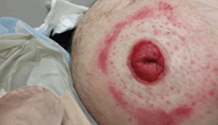 common stoma issues complications,ostomy care,living with an ostomy,stoma issues,peristomal skin irritation,uoaa support groups,colostomy care,ostomy bag fit,stoma bleeding,stoma infection,stoma complications,stoma stenosis,bowel obstruction with stoma,retracted stoma,prolapsed stoma,parastomal hernia,stoma necrosis,ostomate challenges,ostomy support,ostomy health,peristomal care tips,ostomy adjustment,ostomy complications,stoma care tips,ostomy bag leakage,ostomy hygiene,ostomy lifestyle,peristomal skin health,ostomy bag selection,urostomy care,ostomy bag allergies,stoma bleeding causes,stoma infection prevention,stenosis treatment,bowel obstruction symptoms,retracted stoma solutions,prolapsed stoma management,parastomal hernia repair,stoma necrosis causes,ostomy support resources,coping with ostomy changes