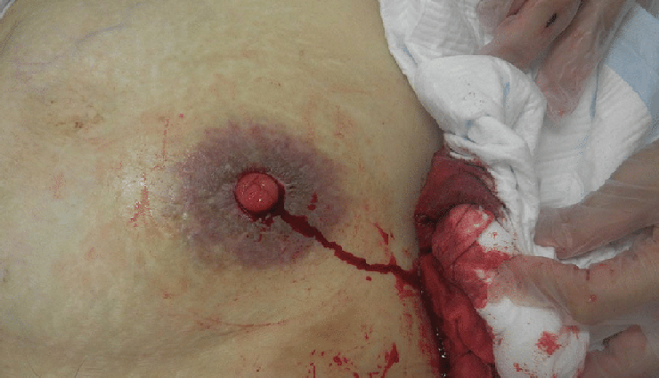 stoma issues,stoma complications,ostomy surgery,temporary ostomy,permanent ostomy,stoma care,peristomal skin irritation,stoma bleeding,stoma infection,stenosis,bowel obstruction,retracted stoma,prolapsed stoma,parastomal hernia,stoma necrosis,ostomy support group,ostomy resources,united ostomy associations of america (uoaa),ostomy nurse,ostomy management