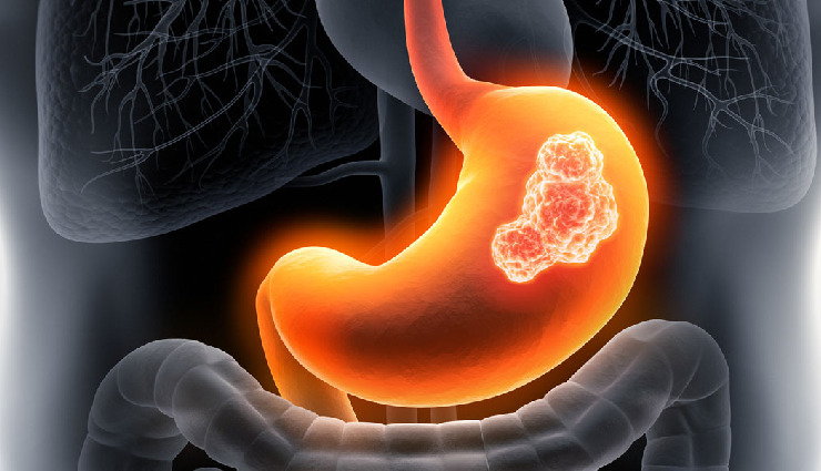8 Major Warning Signs To Look Out for Stomach Cancer