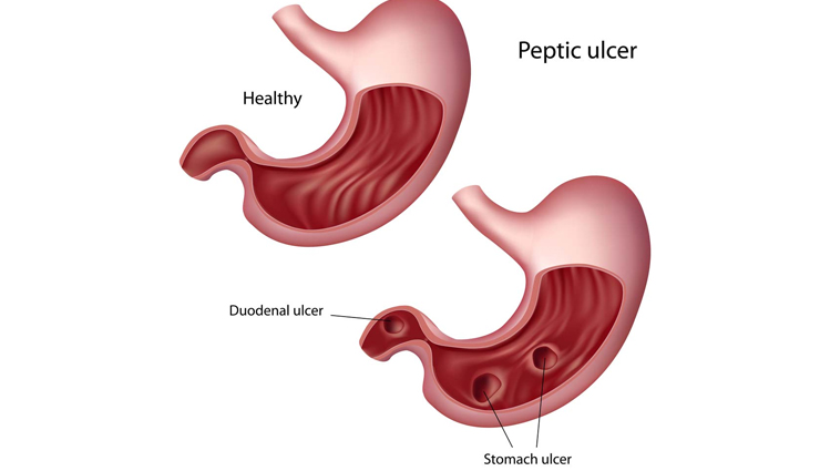 Health tips,healthy living,5 weight loose diseases,what are you suffering from when you loose weight,know what you are suffering from when you loose weight