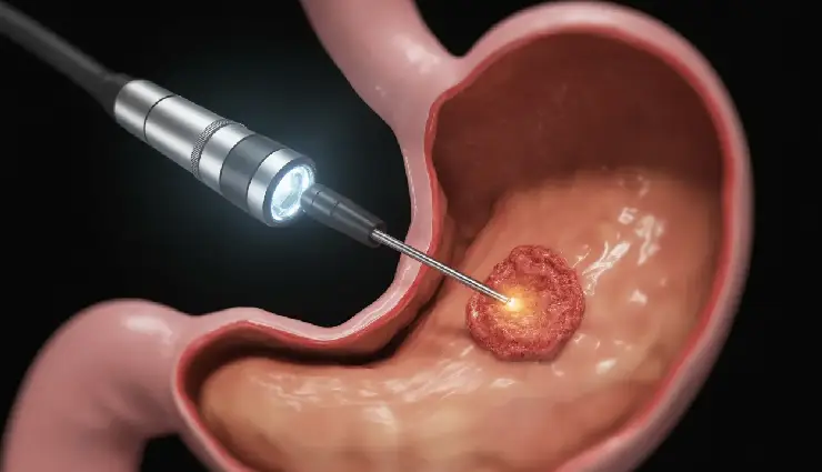 6 Effective Home Remedies To Treat Stomach Ulcer