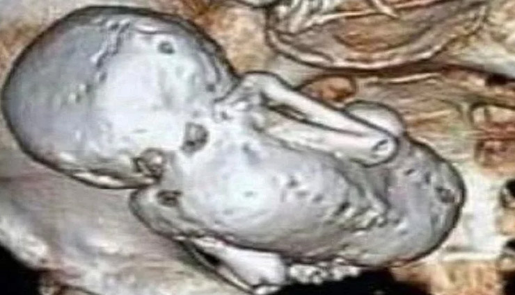 महिला के पेट में 35 साल से पल रहा था भ्रूण! 2 किलो का 'स्टोन बेबी' देख डॉक्टर्स के उड़े होश
