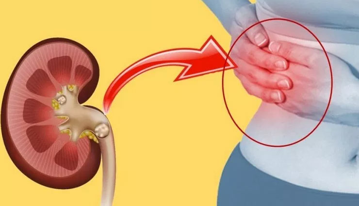 इन चीजों का अधिक सेवन बनता है पथरी का कारण, जाने और बचे