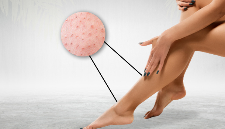 strawberry legs,home remedies for strawberry legs,how to treat strawberry legs,natural treatments for strawberry legs,remove strawberry legs,get rid of dark pores on legs,smooth legs remedies,clogged pores legs treatment,strawberry skin cure,shaving bumps legs,ingrown hairs on legs,diy strawberry legs remedies