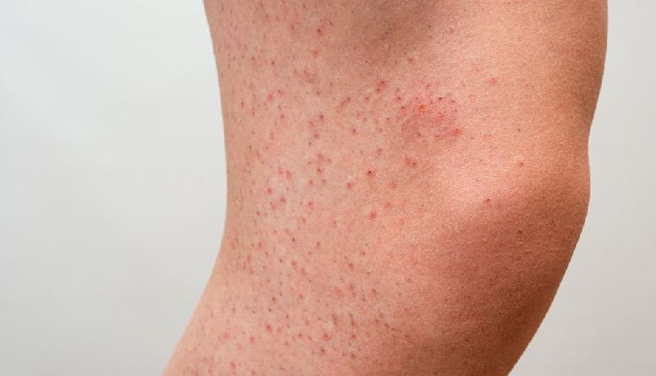 8 Effective DIY Remedies To Treat Strawberry Legs