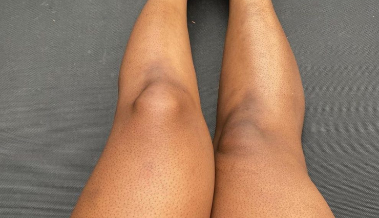 6 Amazing Home Remedies To Treat Strawberry Legs