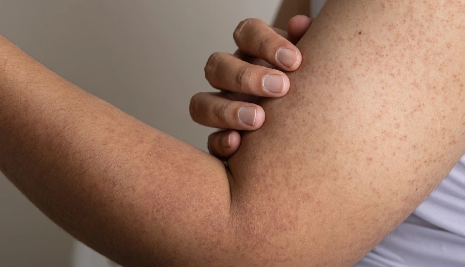 घर पर करें स्ट्रॉबेरी स्किन का इलाज – पाएं मुलायम और चमकदार त्वचा फिर से!