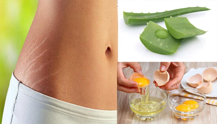 beauty tips,beauty tips in hindi,home remedies,stretch marks,stretch marks remedies
