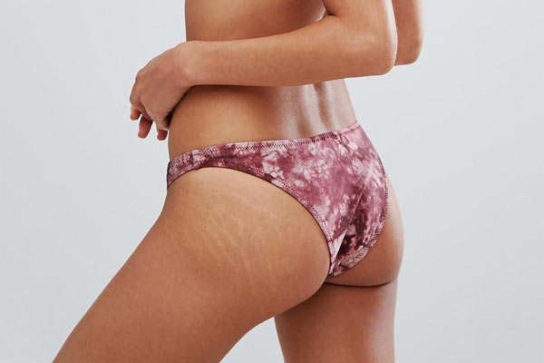 home remedies,removing stretch marks,stretch marks removal tips,Health tips,healthy living