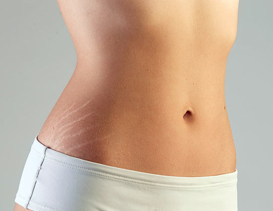 प्रेगनेंसी के बाद बने स्ट्रेच मार्क्स दूर करने के उपाय
