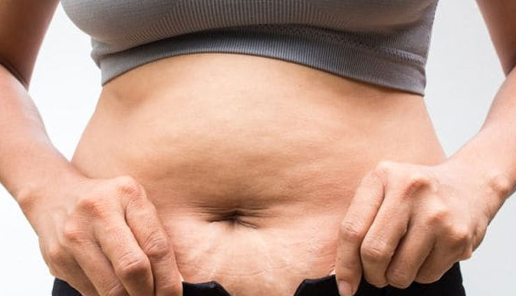 myths about stretch marks,stretch marks,Health tips,fitness tips