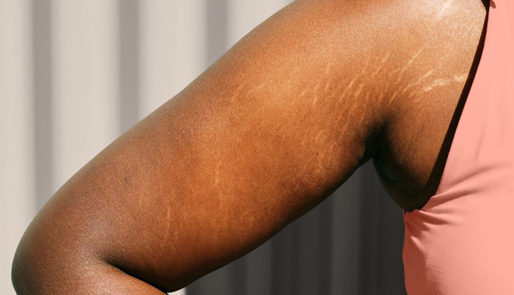 stretch marks,facts about stretch marks,causes of stretch marks,how to prevent stretch marks,stretch marks treatment,home remedies for stretch marks,ways to reduce stretch marks,stretch marks removal,best oils for stretch marks,stretch marks on skin,stretch marks during pregnancy,stretch marks myths and facts,stretch marks cream,natural remedies for stretch marks,skincare for stretch marks