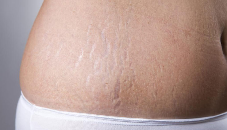 स्ट्रेच मार्क्स घटा रहे आपकी सुन्दरता, इस 1 उपाय से दूर करें यह परेशानी 