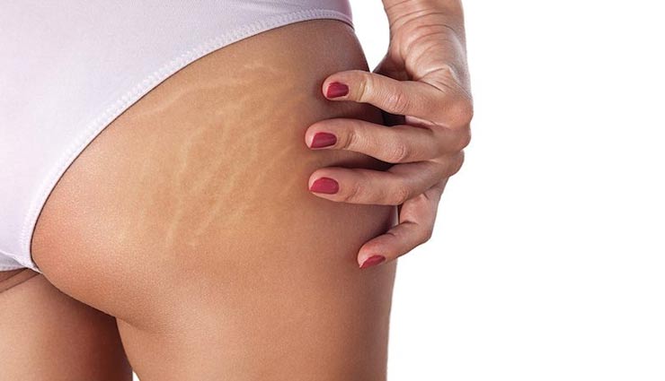 4 Exercises To Help You Get Rid of Stretch Marks