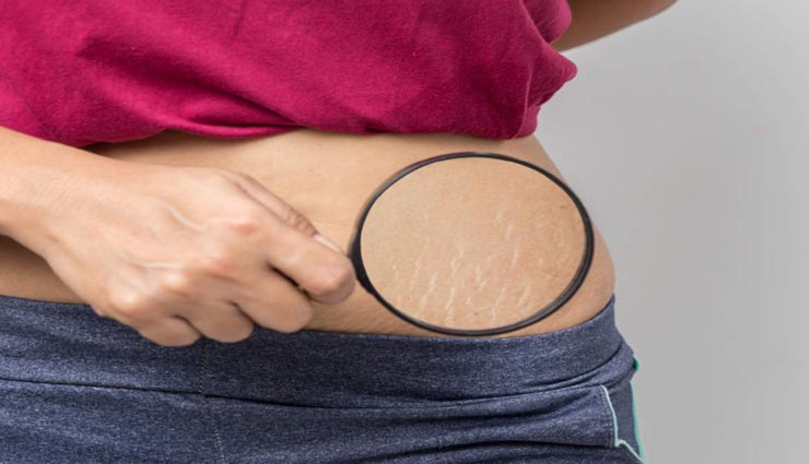 इस उपाय से दूर होगी स्ट्रेच मार्क्स की समस्या, बढ़ेगी त्वचा की खूबसूरती