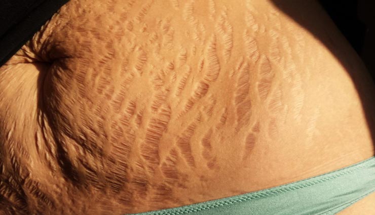 स्ट्रेच मार्क्स घटा रहे हैं त्वचा की खूबसूरती, ये 4 प्राकृतिक उपाय बनेंगे मददगार