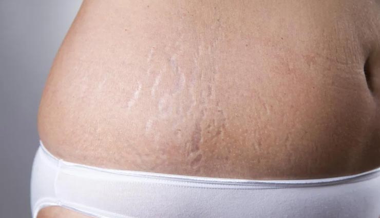 कॉफ़ी की मदद से मिलेगा स्ट्रेच मार्क्स से छुटकारा, इस तरह करना होगा इस्तेमाल