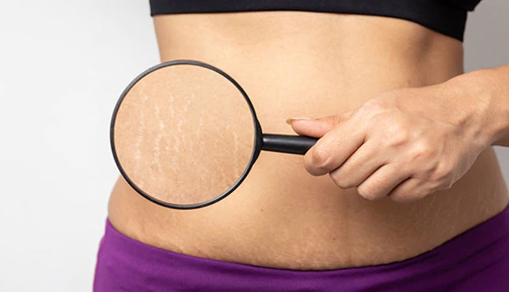 5 Myths About Stretch Marks You Should Completely Ignore