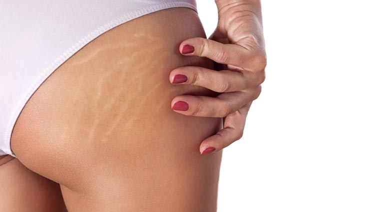 स्ट्रेच मार्क्स से छुटकारा दिलाता हैं कॉफी का यह मास्क