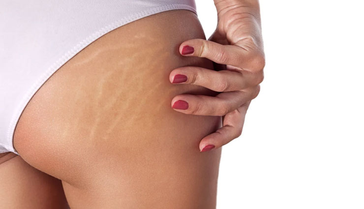 With This Oil You Can Easily Get Rid of Stubborn Stretch Marks