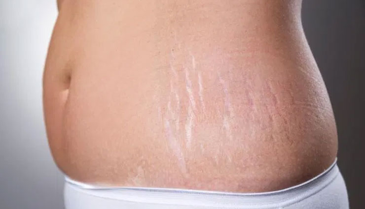 5 Home Remedies To Get Rid of Stretch Marks Permanently