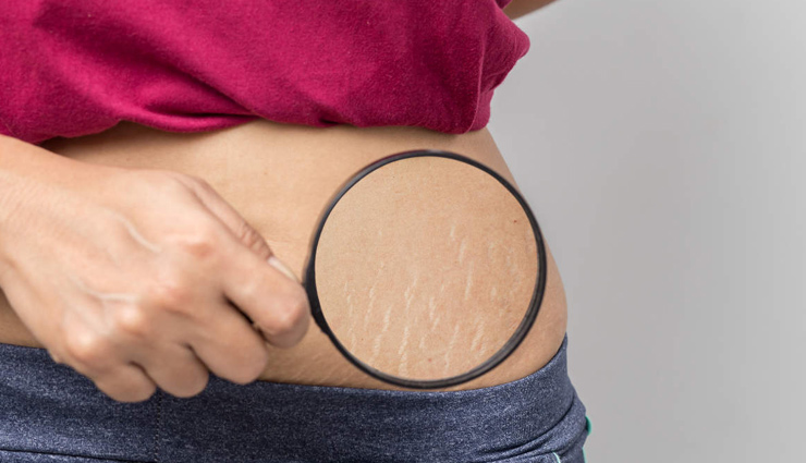 Effective Remedies To Help You Get Rid of Stretch Marks
