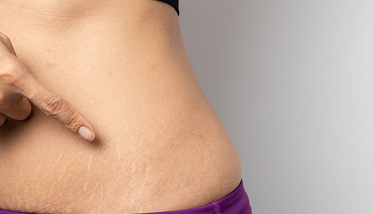 If you are Looking for Natural Ways To Get Rid of Your Stretch Marks, Then We Recommend You to Try The Following Remedies at Home