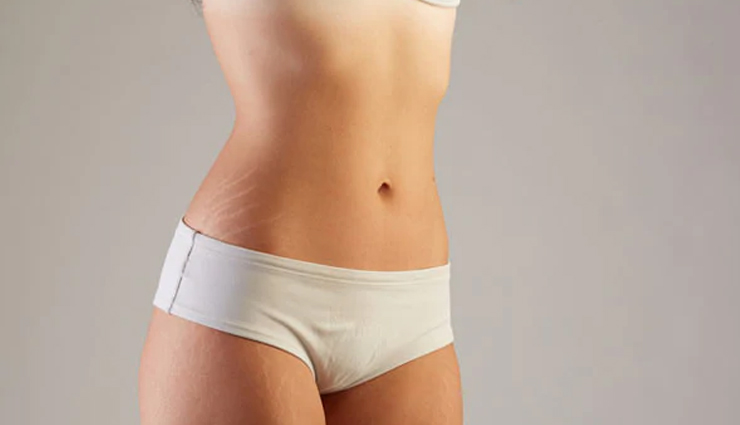 stretch marks,myths about stretch marks,about stretch marks,beauty,skin beauty