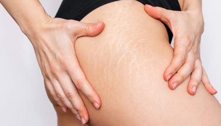 10 Amazing Facts About Stretch Marks No One Told You