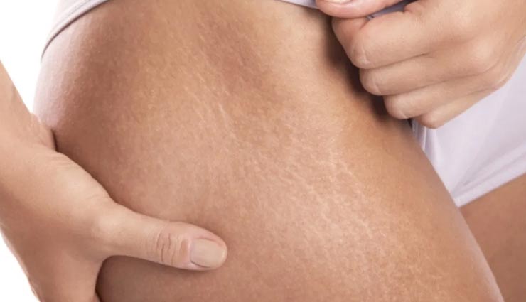 exercises,exercises for stretch marks,Health tips,home remedies
