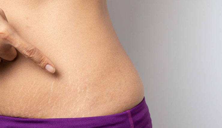 myths about stretch marks,stretch marks,Health tips,fitness tips