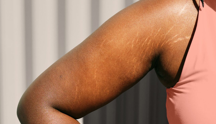 unexpected places where you can get pregnancy stretch marks,beauty tips,beauty hacks