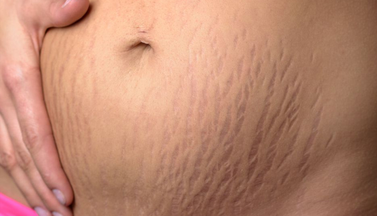 6 Home Remedies To Treat Stretch Marks During Pregnancy