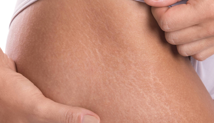 stretch marks,myths about stretch marks,about stretch marks,beauty,skin beauty