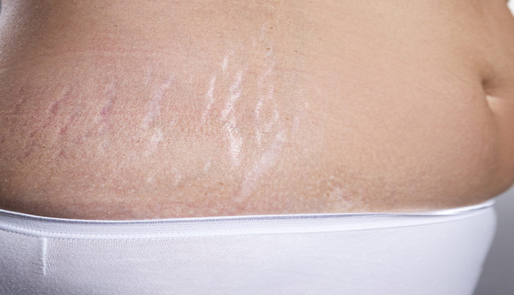 beauty tips,skin care tips,stretch marks remove tips,home remedies for stretch marks