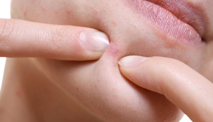 Treat Your Stubborn Acne With These Home Remedies